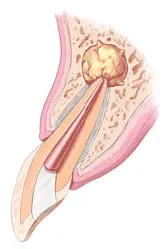 toothside animation of endodontic surgery